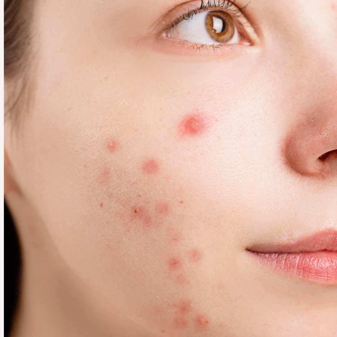 Expert tips to reduce acne